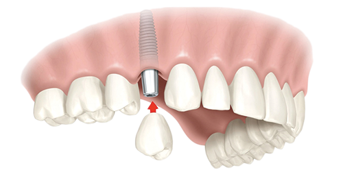 Single Dental Implants Martinsville